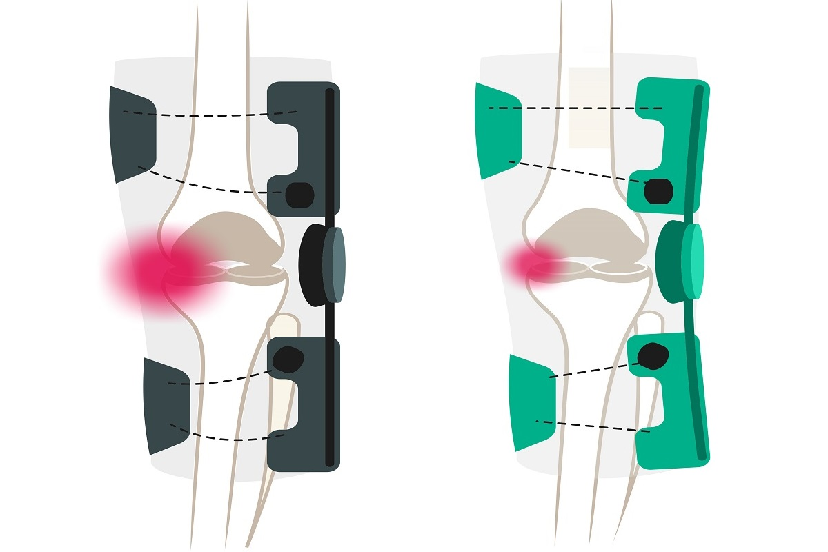 DONJOY® ROAM™ OA Features Schmerzlinderung